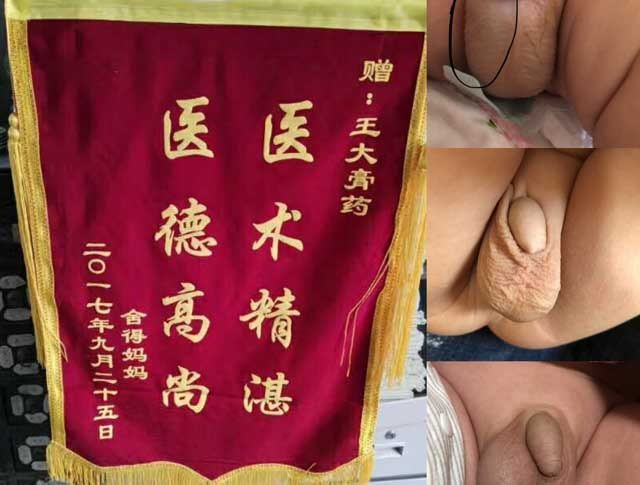 鞘膜积液治疗时机越早越好!