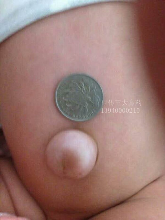 脐疝、王大膏药