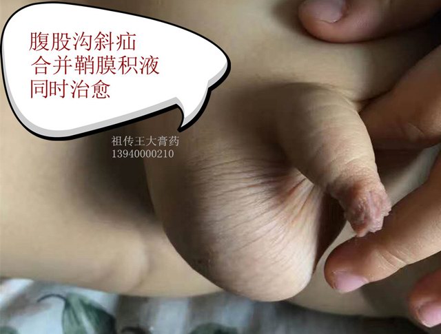 2岁小儿腹股沟斜疝合并鞘膜积液同时治疗痊愈