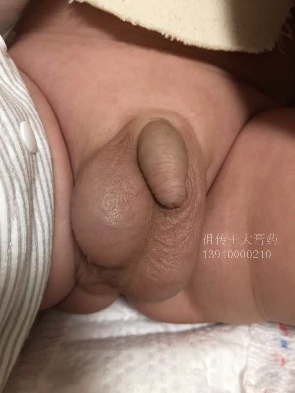 鞘膜积液、水疝