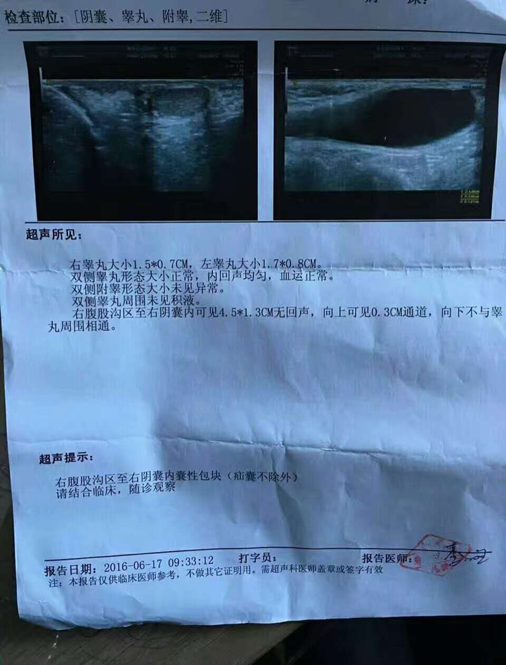 鞘膜积液、腹股沟斜疝、疝气
